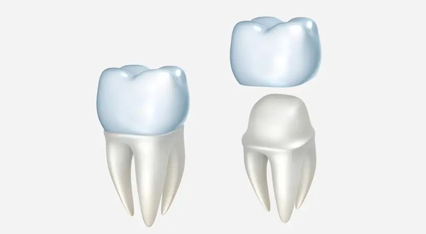 Dental Crowns