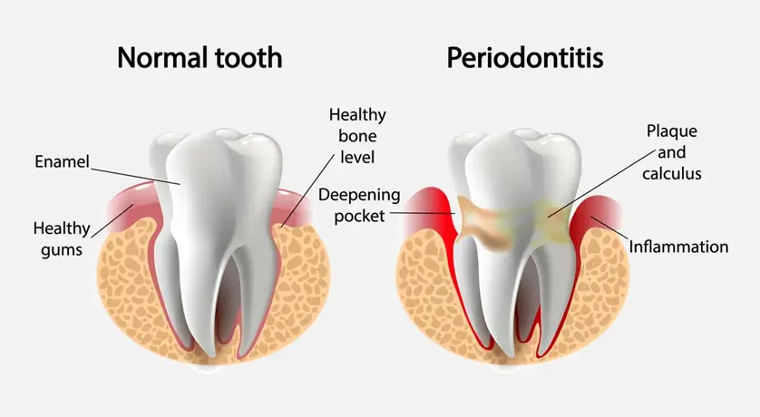 Periodontal Treatment