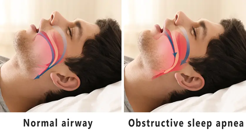 Sleep Apnea Treatment