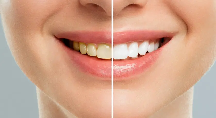 Teeth Whitening